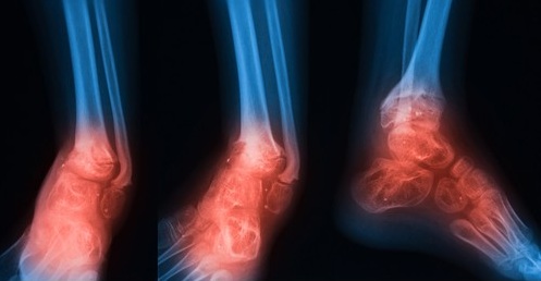 HBOT Treatment Osteomyelitis in Aurangabad